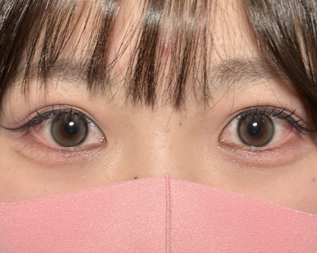 術後
