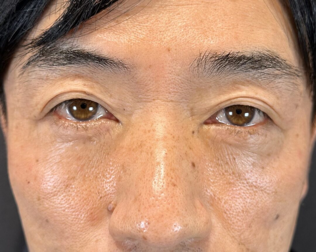 術後