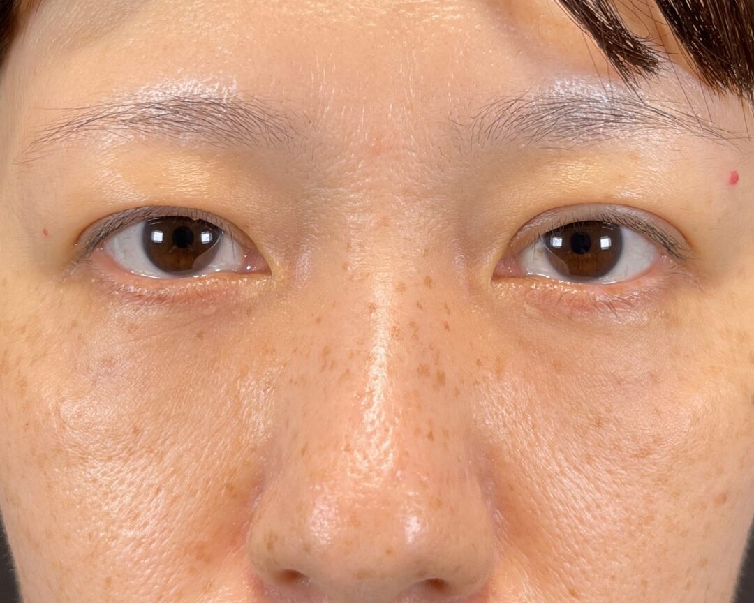 術後