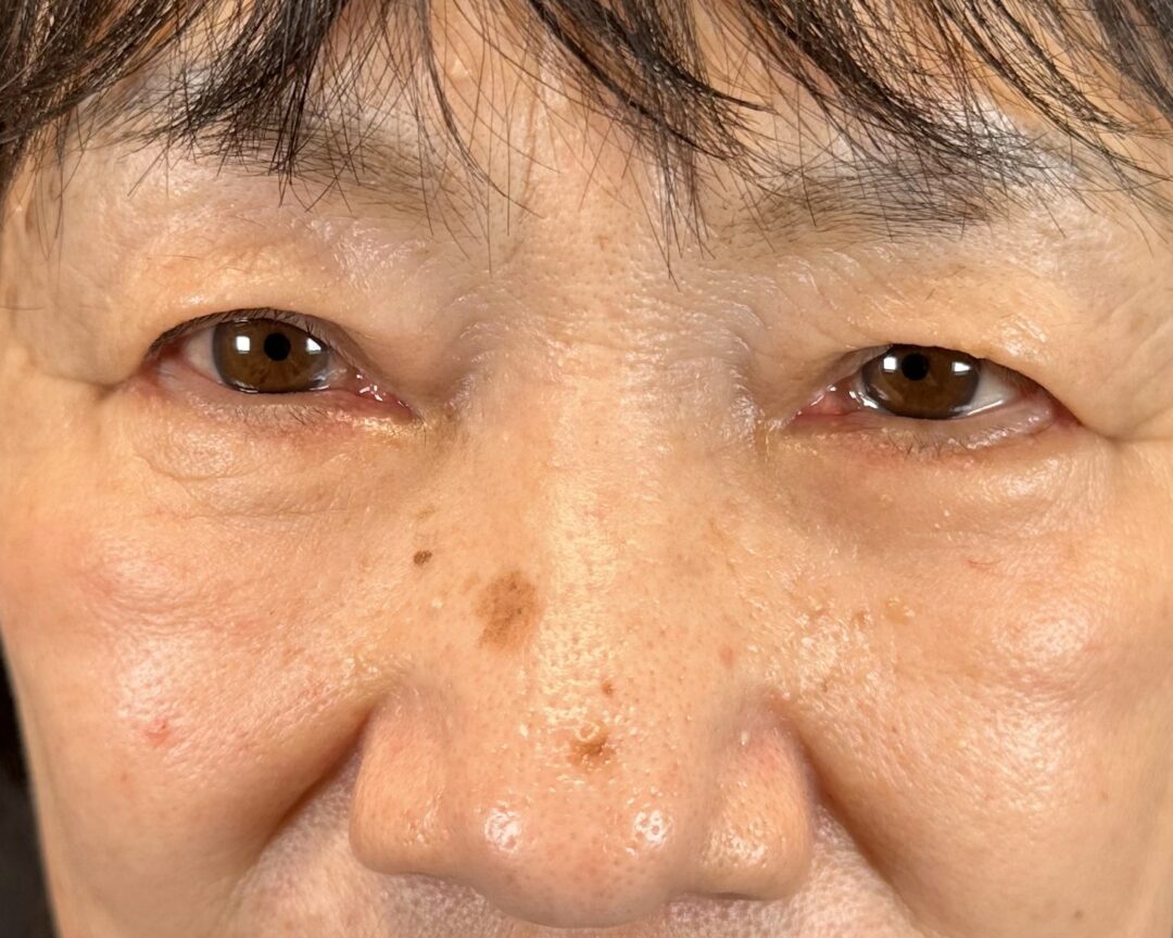 術後