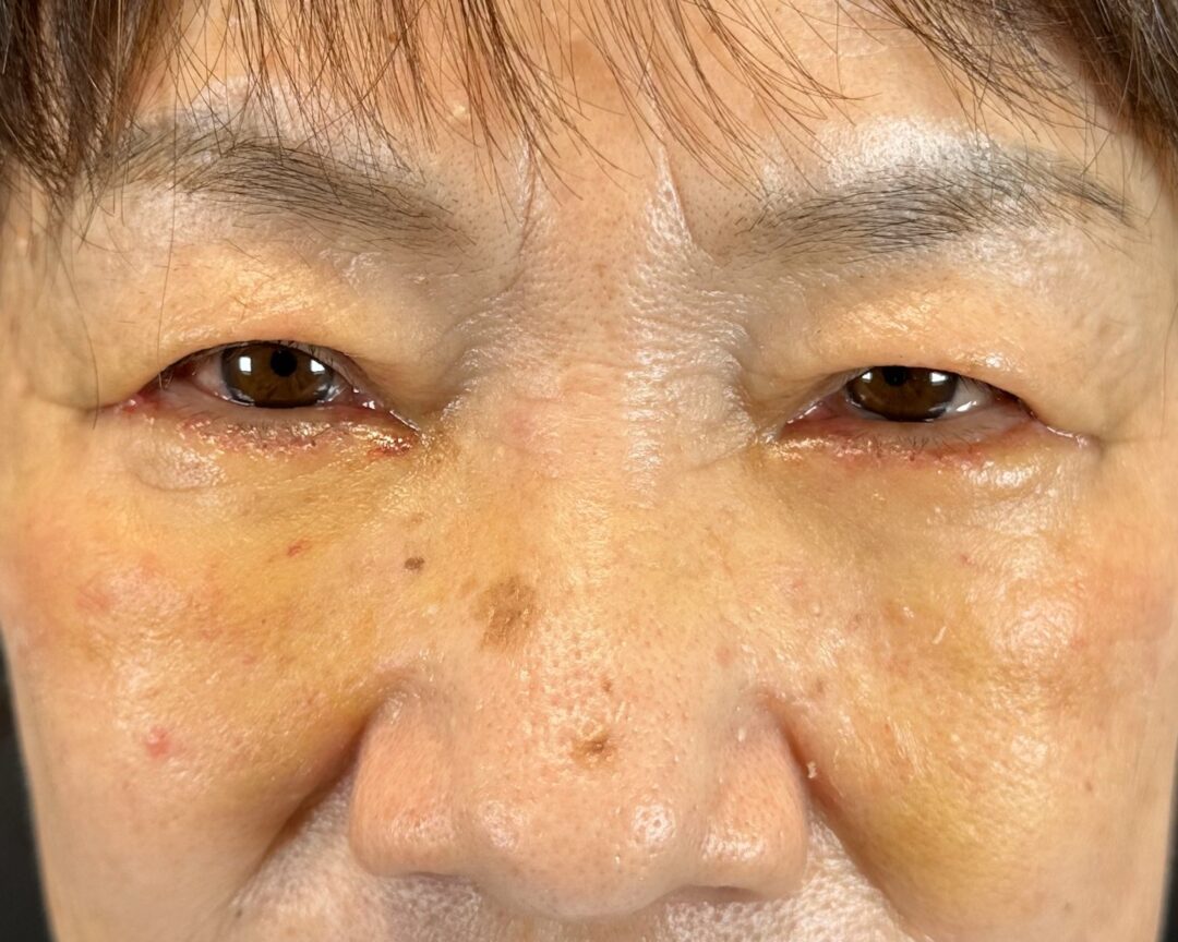 術後