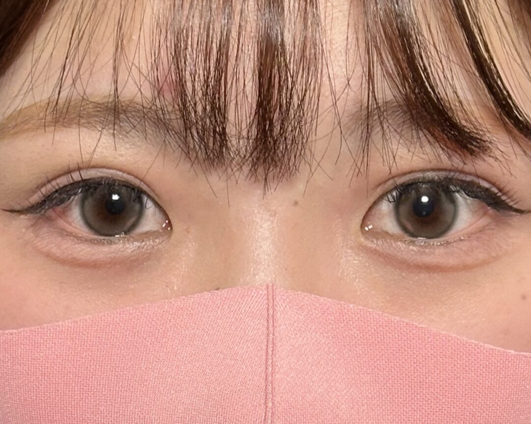 術後