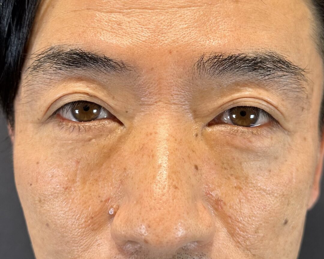 術後