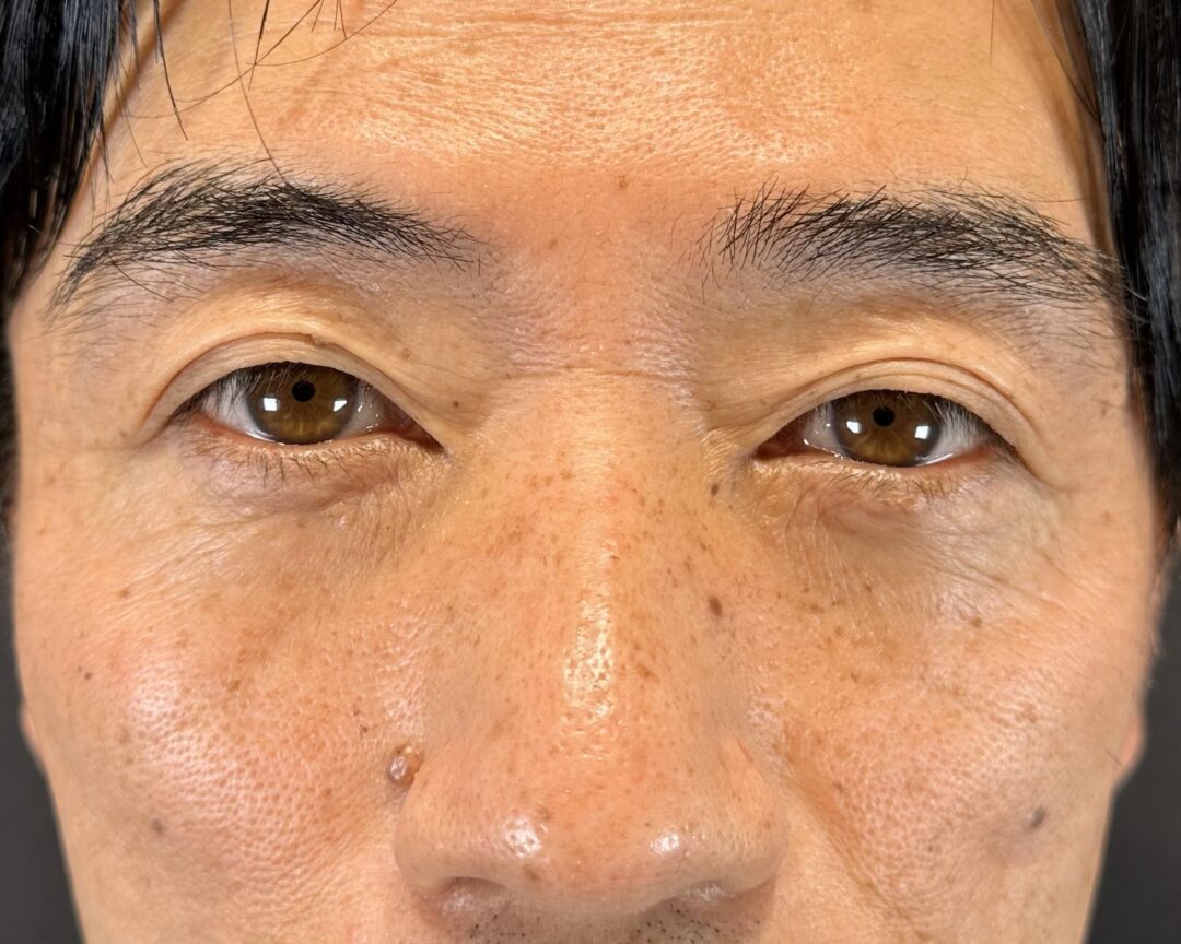 術後
