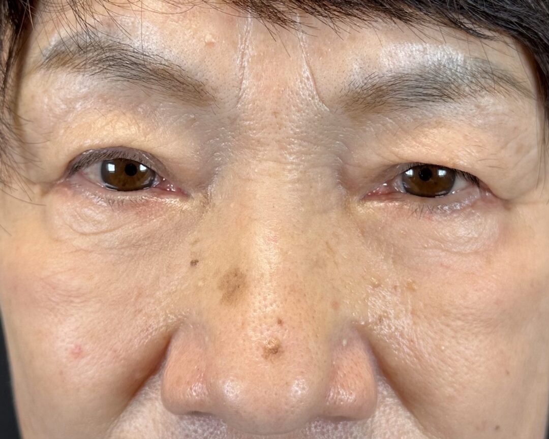 術後