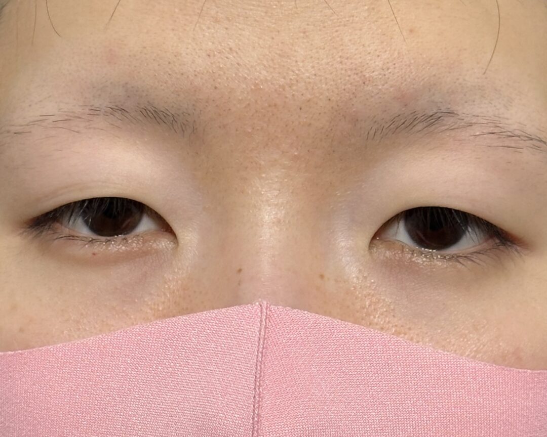 術前