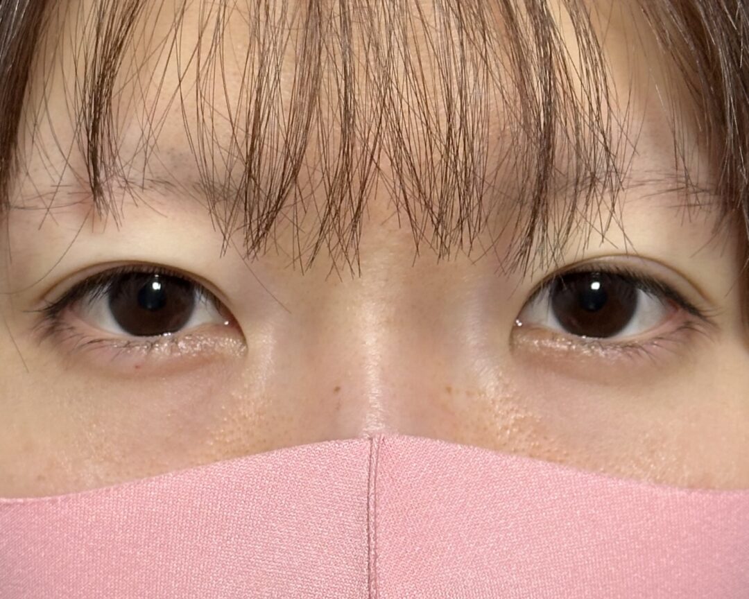 術後