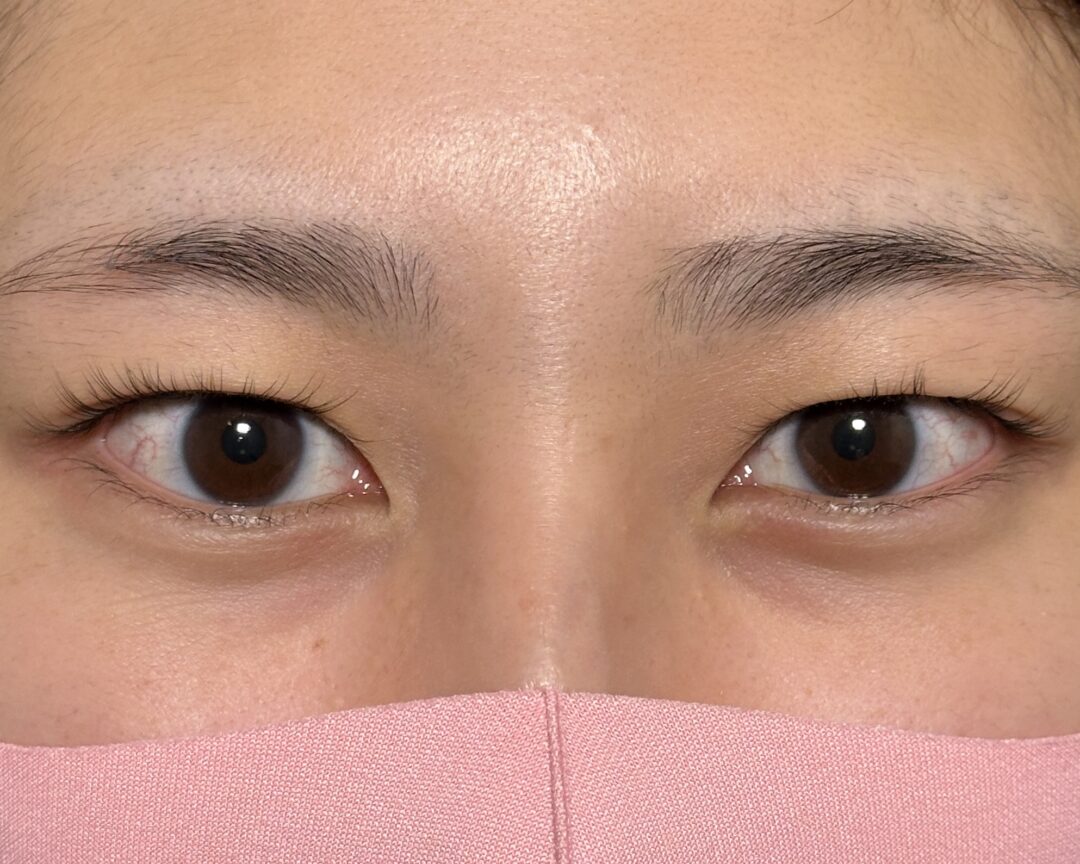 術前