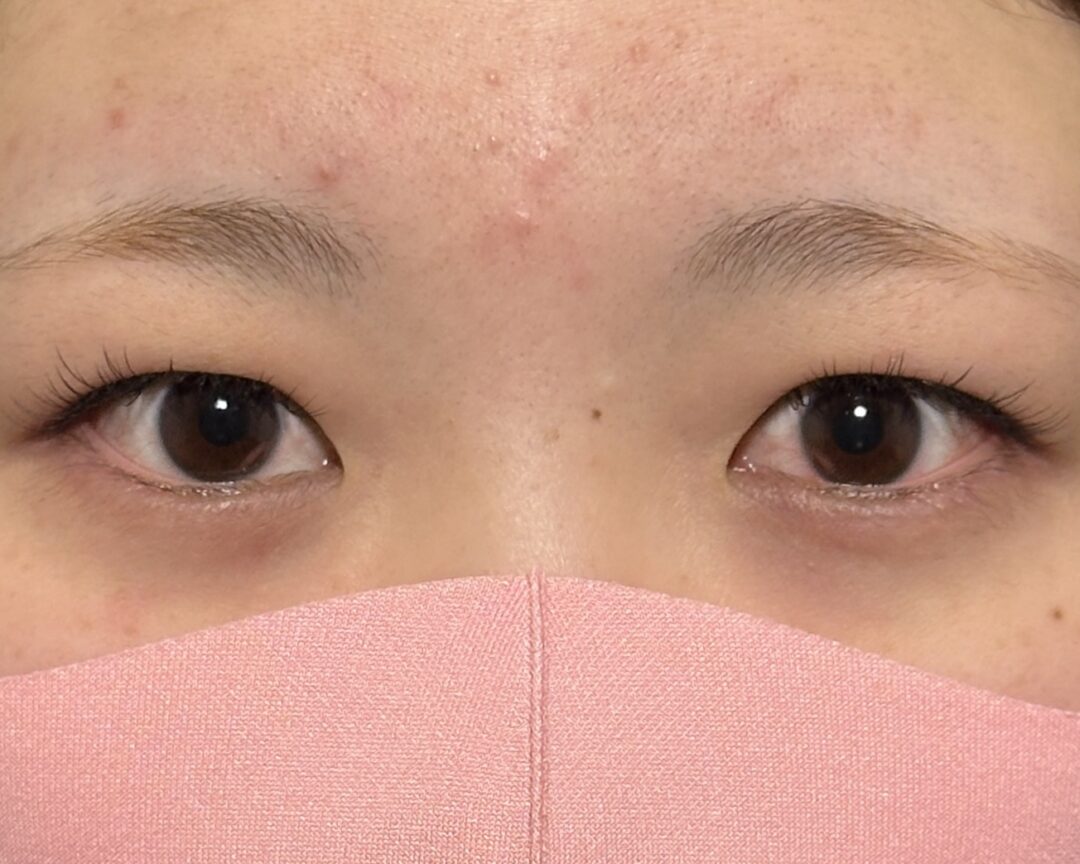 術前