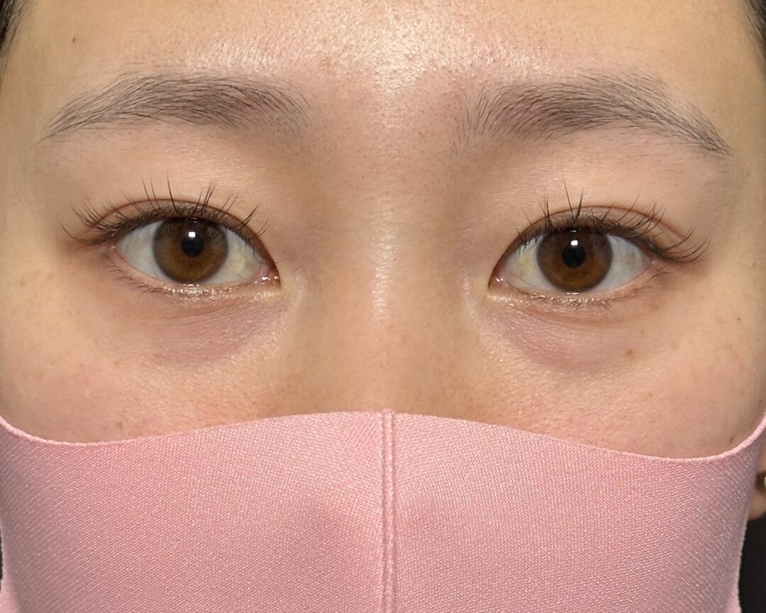 術前