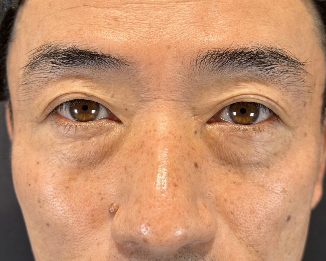 術前