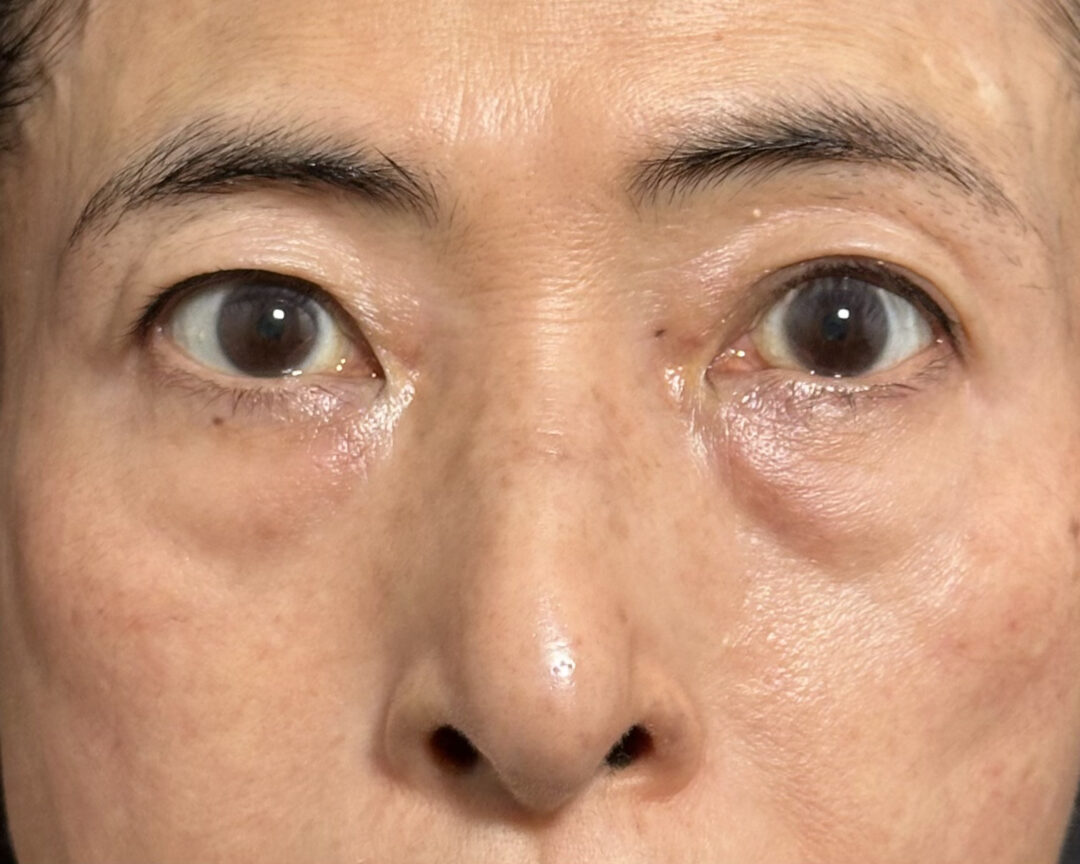 術前