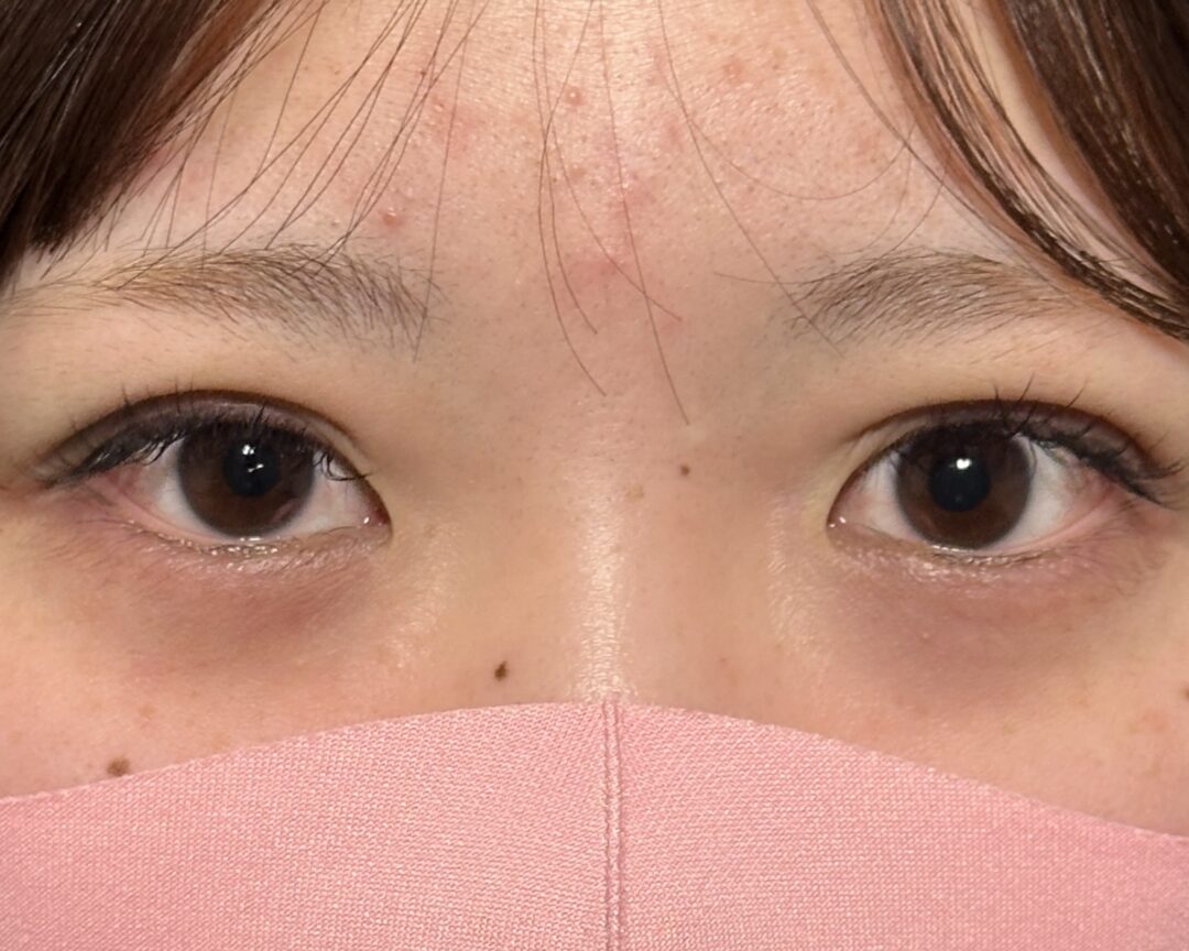 術後