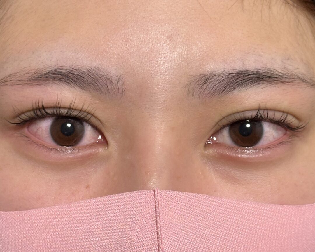術後