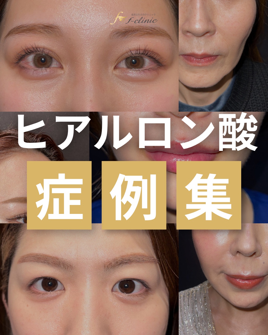 ヒアルロン酸症例